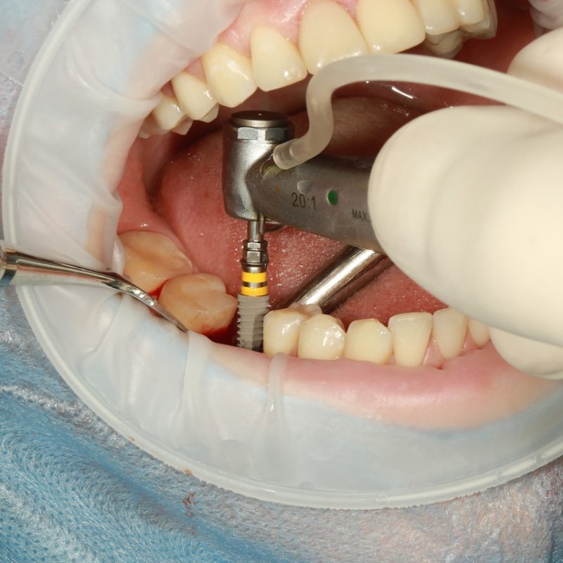 Dental Implants Paradise Dental